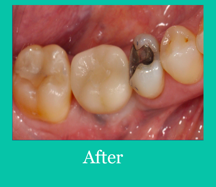 Implant After #2 Image