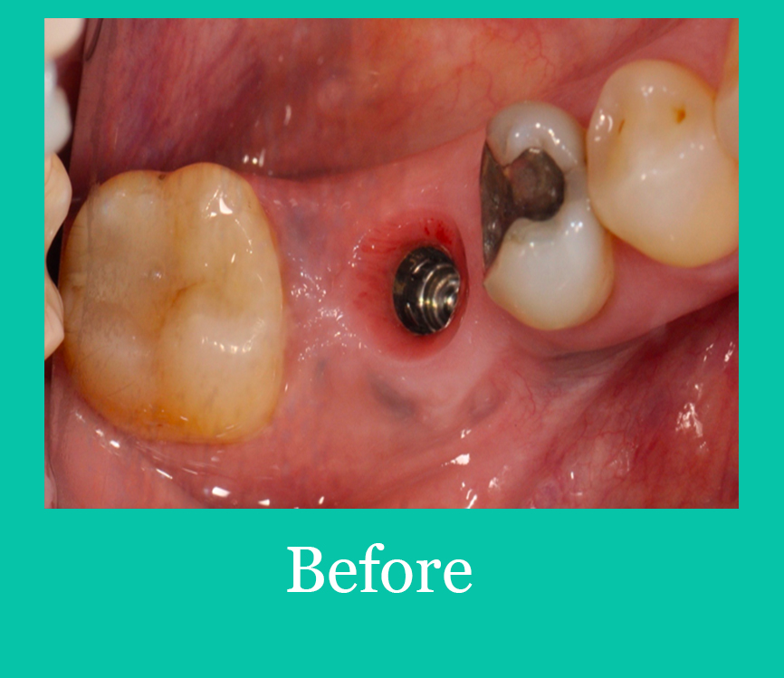 Implant Before Image