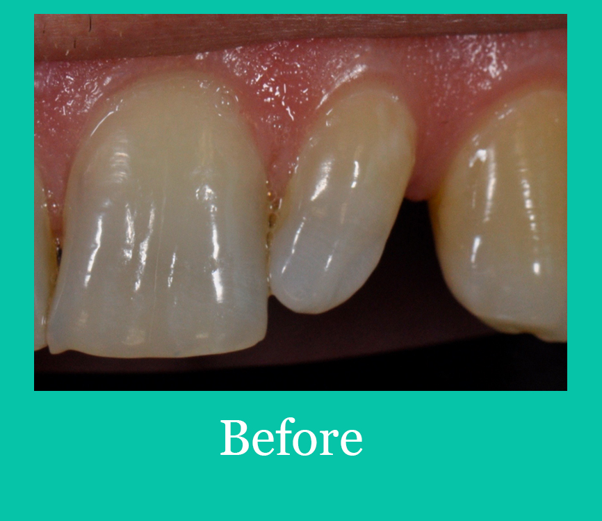 Tooth ReShaping Before Image