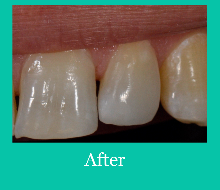 Tooth ReShaping after Image